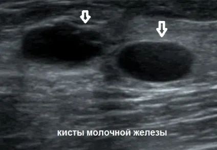 Чи небезпечна кіста молочної залози поради фахівців (залози) Чи небезпечна кіста молочної залози поради фахівців