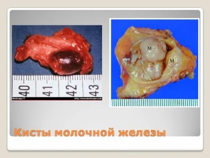 Чи небезпечна кіста молочної залози поради фахівців (молочної) Чи небезпечна кіста молочної залози поради фахівців