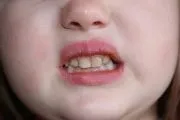 Ортотік види і особливості, показання, принцип дії, ефективність (ортотік фото) Ортотік види і особливості, показання, принцип дії, ефективність