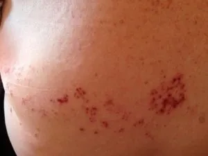Попрілість між сідницями у дорослих причини і лікування (сідницями) Попрілість між сідницями у дорослих причини і лікування