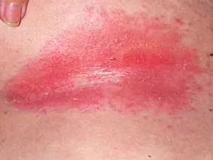 Попрілості в паху у чоловіків і жінок як лікувати, чому возникаю попрілості у дорослих, способи (паху) Попрілості в паху у чоловіків і жінок як лікувати, чому возникаю попрілості у дорослих, способи