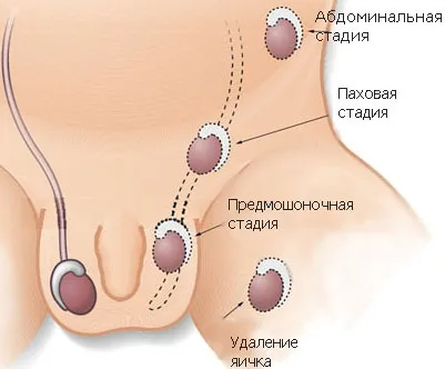 опущення яєчка