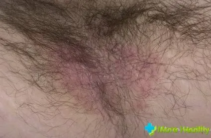 Попрілість між ніг