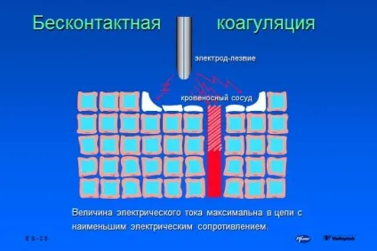 основи електрохірургії