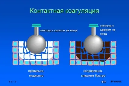 основи електрохірургії