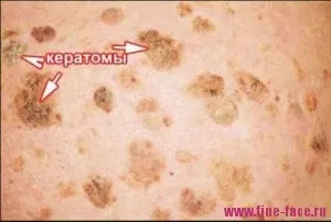 Старечі бородавки вікові кератоми фото, причини, лікування (старечі) Старечі бородавки вікові кератоми фото, причини, лікування