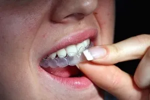 Відбілювання зубів каппами, або пластинами і їх ефективність (каппами) Відбілювання зубів каппами, або пластинами і їх ефективність