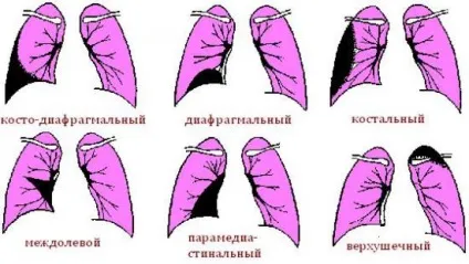 Осумкований плеврит характеристика і лікування (плеврит) Осумкований плеврит характеристика і лікування