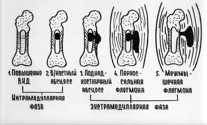 Остеомієліт причини і діагностика захворювання (остеомієліт) Остеомієліт причини і діагностика захворювання