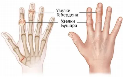 Остеоартроз пальців рук симптоми і лікування народними і традиційними засобами (пальців) Остеоартроз пальців рук симптоми і лікування народними і традиційними засобами