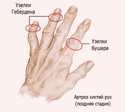 Остеоартроз кистей рук