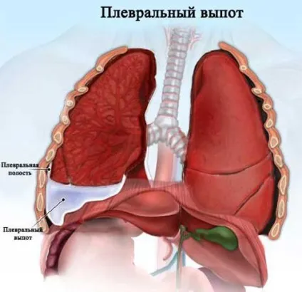 Осумкований плеврит характеристика і лікування (плеври осумкований плеврит) Осумкований плеврит характеристика і лікування