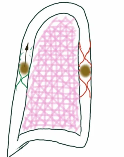 Осумкований плеврит особливості картини, лікувальні заходи (картини) Осумкований плеврит особливості картини, лікувальні заходи