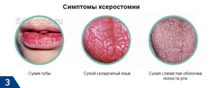 Відбитки зубів на мові з боків все причини виникнення (боків) Відбитки зубів на мові з боків все причини виникнення