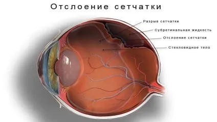 Відшарування сітківки ока що це таке, симптоми, лікування (таке) Відшарування сітківки ока що це таке, симптоми, лікування