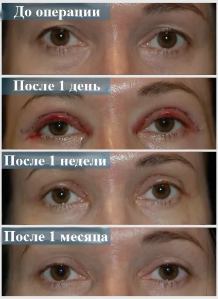 Набряки після блефаропластики нижніх, верхніх повік (набряки) Набряки після блефаропластики нижніх, верхніх повік