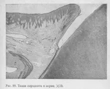 Пародонтит (маргінальний періодонтит), терапевтична стоматологія