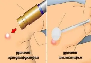 Папілома в вусі чи варто побоюватися, діагностика та методи лікування (лікування) Папілома в вусі чи варто побоюватися, діагностика та методи лікування