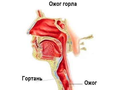 Опік горла симптоми і чим лікувати в домашніх умовах (опік) Опік горла симптоми і чим лікувати в домашніх умовах