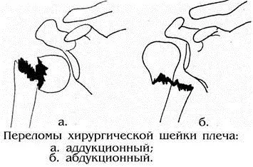 Перелом хірургічної шийки плеча лікування, симптоми і причини (перелом) Перелом хірургічної шийки плеча лікування, симптоми і причини