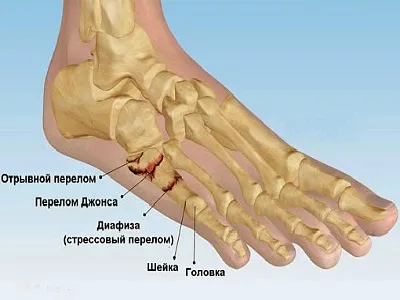 Перелом 5 плеснової кістки стопи скільки ходити в гіпсі, відновлення, симптоми і лікування (перелом) Перелом 5 плеснової кістки стопи скільки ходити в гіпсі, відновлення, симптоми і лікування