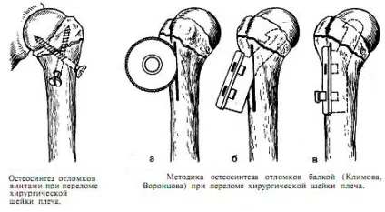 Перелом хірургічної шийки плеча лікування, симптоми і причини (перелом хірургічної шийки плеча) Перелом хірургічної шийки плеча лікування, симптоми і причини