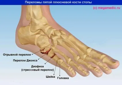 Перелом плеснової кістки стопи (стопи) Перелом плеснової кістки стопи