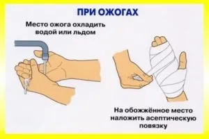 Перша допомога при опіку окропом в домашніх умовах (домашніх) Перша допомога при опіку окропом в домашніх умовах