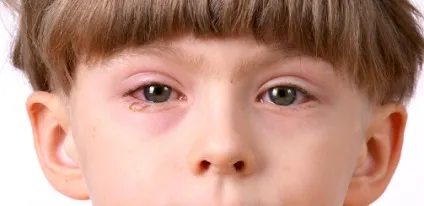 Перша допомога при алергічних реакціях (швидку медичну допомогу) Перша допомога при алергічних реакціях
