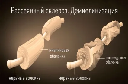 Харчування хворих на розсіяний склероз дієта, меню, рецепти, відгуки лікарів (хворих) Харчування хворих на розсіяний склероз дієта, меню, рецепти, відгуки лікарів
