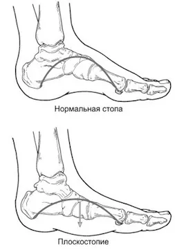 Плоскостопість - симптоми, ступеня і лікування плоскостопості (плоскостопості) Плоскостопість - симптоми, ступеня і лікування плоскостопості