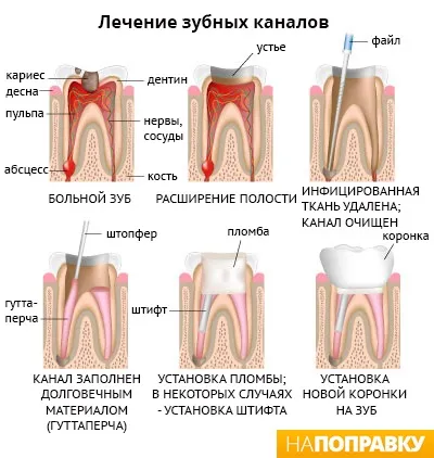 Пломбування зубів (зубних каналів) загальні відомості і догляд - напоправку (пломбування) Пломбування зубів (зубних каналів) загальні відомості і догляд - напоправку
