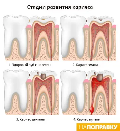 Пломбування зубів (зубних каналів) загальні відомості і догляд - напоправку (пломбування) Пломбування зубів (зубних каналів) загальні відомості і догляд - напоправку