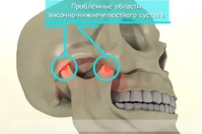 Чому болить щелепа справа і зліва, причини болю у верхній і нижній щелепі (болить) Чому болить щелепа справа і зліва, причини болю у верхній і нижній щелепі