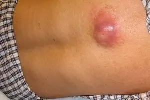 З яких причин може виникнути атерома на спині і що робити при її запаленні (спині) З яких причин може виникнути атерома на спині і що робити при її запаленні