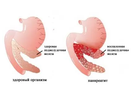 Показання до застосування панкреатину в таблетках (таблетках) Показання до застосування панкреатину в таблетках