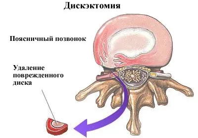 Поперековий стеноз хребетного каналу причини, діагностика, лікування, ускладнення (хребетного) Поперековий стеноз хребетного каналу причини, діагностика, лікування, ускладнення