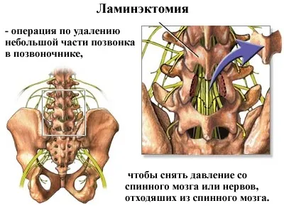 Поперековий стеноз хребетного каналу причини, діагностика, лікування, ускладнення (стеноз) Поперековий стеноз хребетного каналу причини, діагностика, лікування, ускладнення