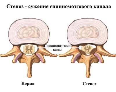 Поперековий стеноз хребетного каналу причини, діагностика, лікування, ускладнення (діагностика) Поперековий стеноз хребетного каналу причини, діагностика, лікування, ускладнення