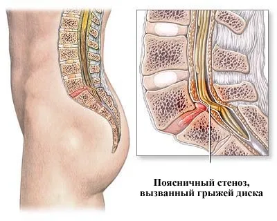 Поперековий стеноз хребетного каналу причини, діагностика, лікування, ускладнення (стеноз) Поперековий стеноз хребетного каналу причини, діагностика, лікування, ускладнення