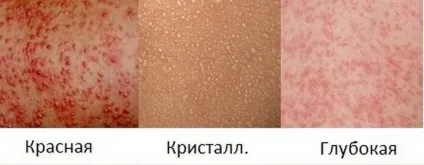 Пітниця - причини виникнення, симптоми, лікування (виникнення) Пітниця - причини виникнення, симптоми, лікування