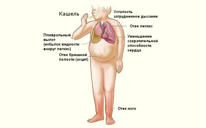 Постінфарктний кардіосклероз симптоми і лікування (симптоми) Постінфарктний кардіосклероз симптоми і лікування