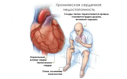 Постінфарктний кардіосклероз симптоми і лікування (симптоми) Постінфарктний кардіосклероз симптоми і лікування