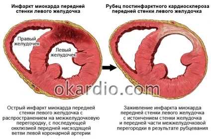 Постінфарктний кардіосклероз що це таке, симптоми і лікування, види (симптоми) Постінфарктний кардіосклероз що це таке, симптоми і лікування, види