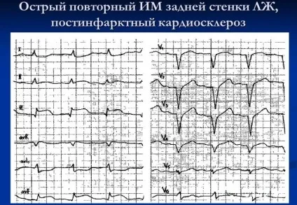 Постінфарктний кардіосклероз симптоми і лікування (постінфарктний) Постінфарктний кардіосклероз симптоми і лікування