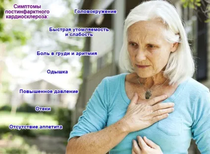 Постінфарктний кардіосклероз що це таке, симптоми і лікування, види (лікування) Постінфарктний кардіосклероз що це таке, симптоми і лікування, види