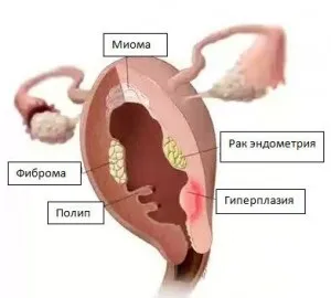 Переривчасті місячні (причини виникнення)