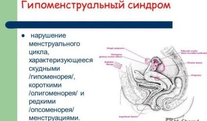 Переривчасті місячні - з перервою 1 день причини (переривчасті) Переривчасті місячні - з перервою 1 день причини