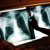 Примусова госпіталізація хворих на туберкульоз, відмова від лікування в стаціонарі