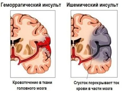 Причини і наслідки інсульту у чоловіків, жінок (інсульту) Причини і наслідки інсульту у чоловіків, жінок